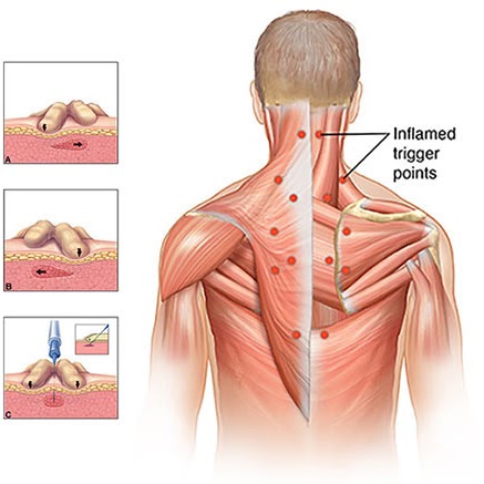 Trigger-Point-Injections-Doctor-Back-Specialist-NY Neck Pain Downtown