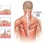 Trigger-Point-Injections-Do... - Neck Pain Downtown