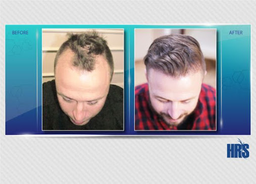 hair transplant, hair transplant cost, hair plugs, HRS Hair Restoration Specialists