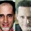hair transplant, hair trans... - HRS Hair Restoration Specia...