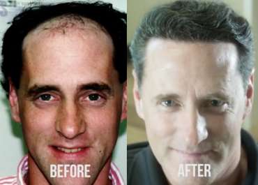hair transplant, hair transplant cost, hair plugs, HRS Hair Restoration Specialists