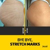 stretch mark removal - Formah Brazilian Beauty Cen...