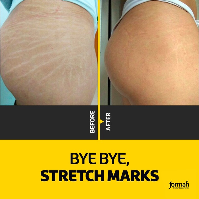 stretch mark removal Formah Brazilian Beauty Center - Alpharetta