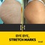stretch mark removal - Formah Brazilian Beauty Center - Alpharetta