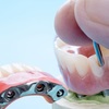 Fixed Partial Denture In Mo... - Texla Dental