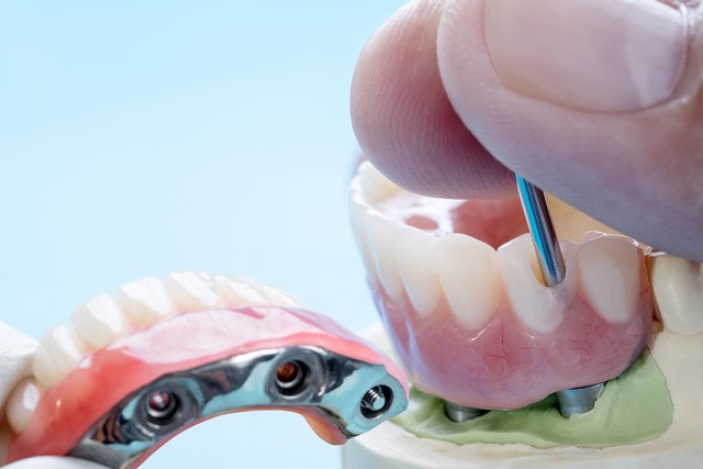 Fixed Partial Denture In Mohali Texla Dental