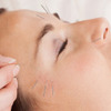 Cosmetic-Acupuncture1-214x131 - Toronto Weight Loss and Wel...