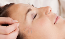 Cosmetic-Acupuncture1-214x131 Toronto Weight Loss and Wellness Clinic