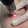 Laser Tattoo Removal - Picture Box