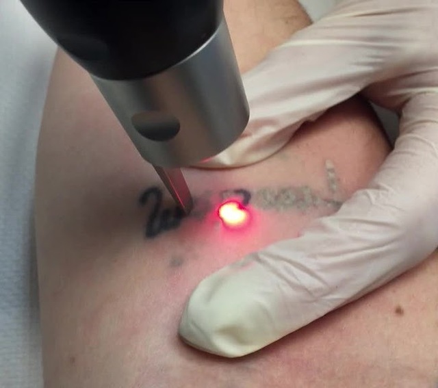 Laser Tattoo Removal Picture Box