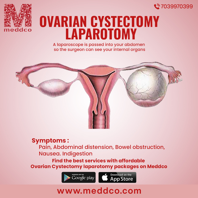 ovarian cystectomy laparotomy 1 Ovarian Cystectomy laparotomy
