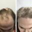 Hair Transplant Clinic - Picture Box