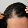 Follicle Fix Hair Regrowth ... - Follicle Fix Hair Regrowth