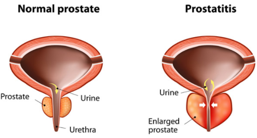 gorila-flow What is Gorilla Flow Prostate?