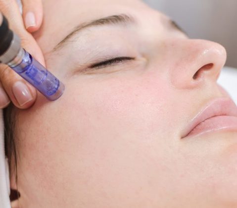 Microneedling - Anonymous