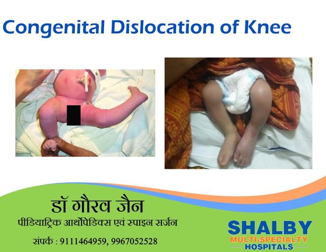 Congenital Dislocation of knee Picture Box