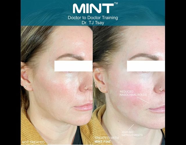 Best Minimally Invasive Face Lift mintpdo - geo tag