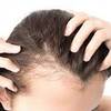 Hair Scalp Micropigmentation - Picture Box