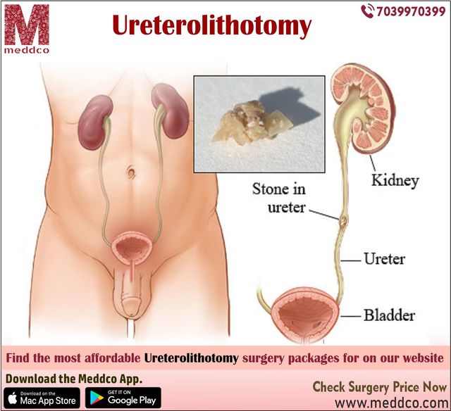 Ureterolithotomy Picture Box