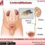 Ureterolithotomy - Picture Box