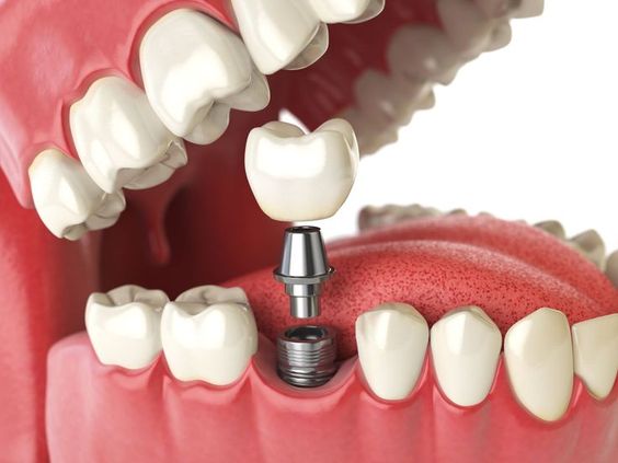 Best Dental Implant Clinic In South Delhi drsahnisdental