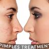 Pimples-treatment - Picture Box