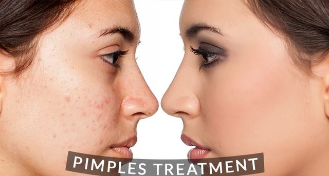 Pimples-treatment Picture Box