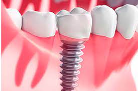 cosmetic dentistry Dubai Picture Box