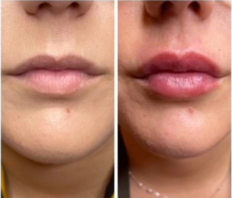 Dermal Fillers Picture Box