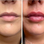 Dermal Fillers - Picture Box