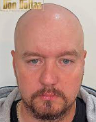 Scalp Micropigmentation Picture Box