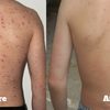 Male-Acne-Treatment - Jimmy Bodur