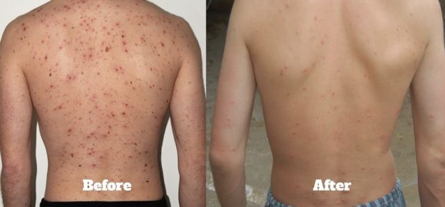 Male-Acne-Treatment Jimmy Bodur