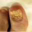 Male Nail Fungal Treatment - Jimmy Bodur