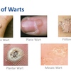 Wart-Laser-Therapy - Jimmy Bodur