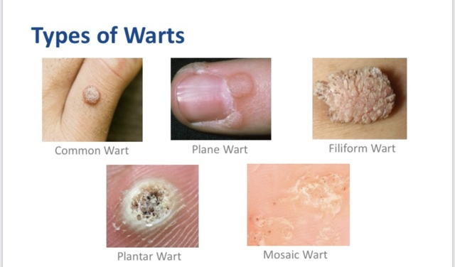 Wart-Laser-Therapy Jimmy Bodur