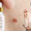 Amarose Skin Tag Remover