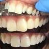 Teeth Whitening Dentist in Augusta, GA