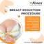 Breast Reduction Surgery Co... - Picture Box