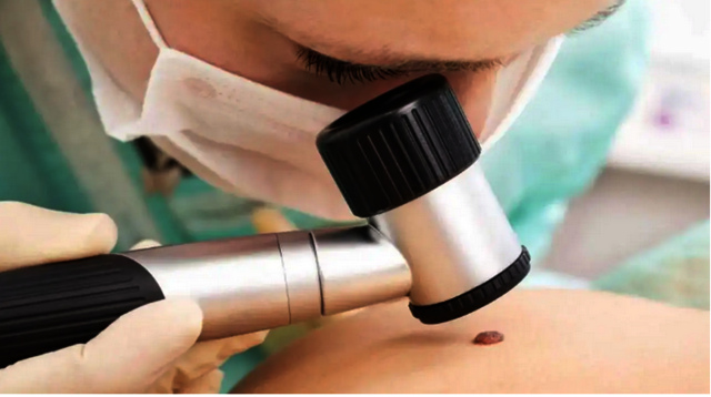 paradise skin tag remover pic Picture Box