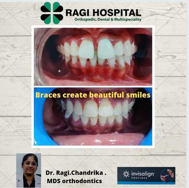 Best Dental Clinic in Kukatpally,Hyderabad Braces Create Beautiful SmilesðŸ˜„