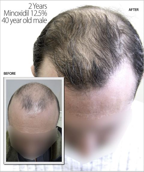 Re-grow Your Beard with Minoxidil Torontohairtransplant