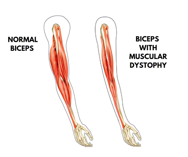 Best Stem Cell Treatment for Muscular Dystrophy Di Picture Box