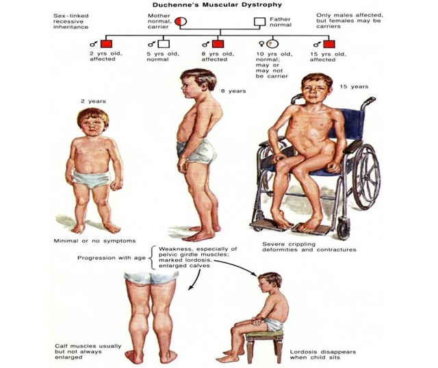 Best Stem Cell Treatment for Muscular Dystrophy Di Picture Box