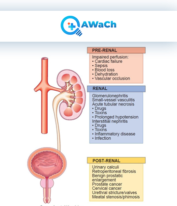 Acute-kidney-injury Picture Box