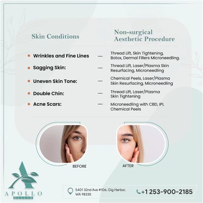 Microneedling in Gig Harbor377762715 3407934083366 Picture Box