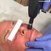 Microneedling in Gig Harbor... - Picture Box