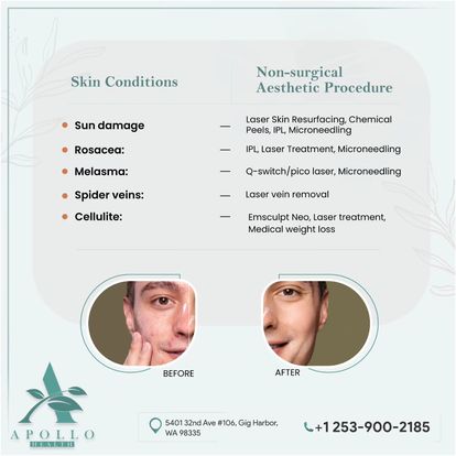 Microneedling in Gig Harbor384101805 3418140682346 Picture Box