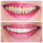 Teilkronen-und-Veneers - ZahnÃ¤rztin MÃ¼nchen Dr. Strehlow | Ã„sthetische Zahnmedizin, Veneers, CMD |