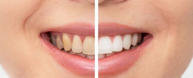 Cost of Teeth Whitening in Andheri, Mumbai Picture Box